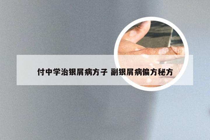 付中学治银屑病方子 副银屑病偏方秘方