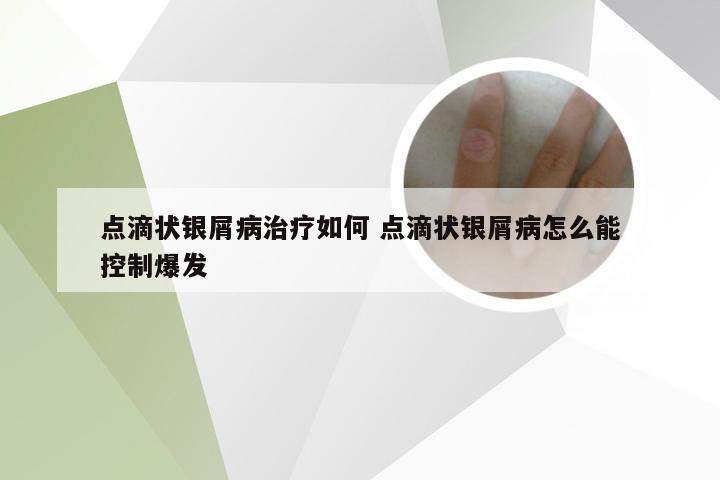点滴状银屑病治疗如何 点滴状银屑病怎么能控制爆发