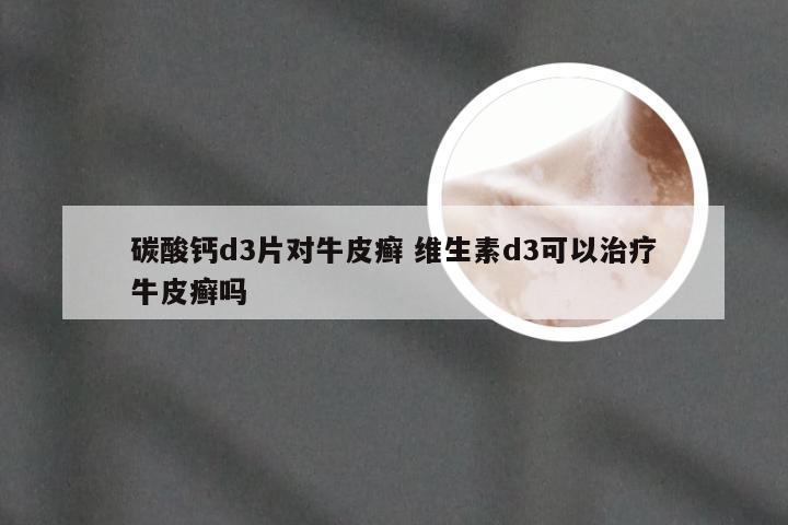 碳酸钙d3片对牛皮癣 维生素d3可以治疗牛皮癣吗