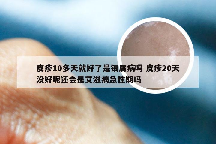 皮疹10多天就好了是银屑病吗 皮疹20天没好呢还会是艾滋病急性期吗