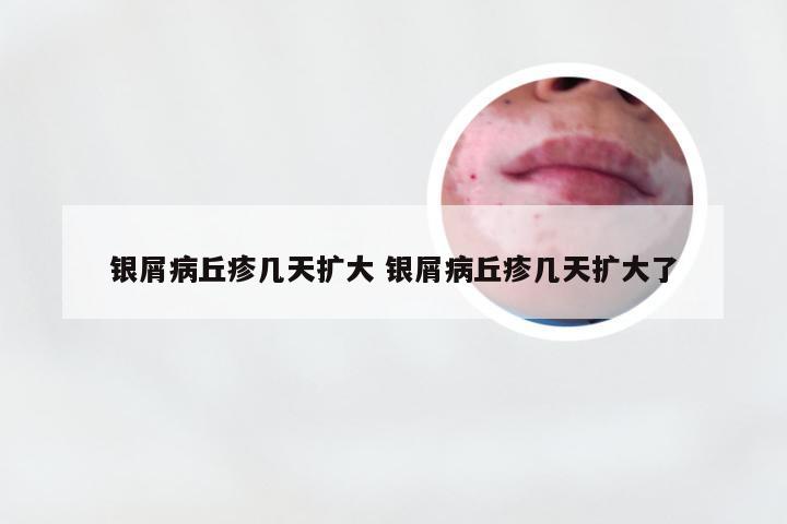 银屑病丘疹几天扩大 银屑病丘疹几天扩大了