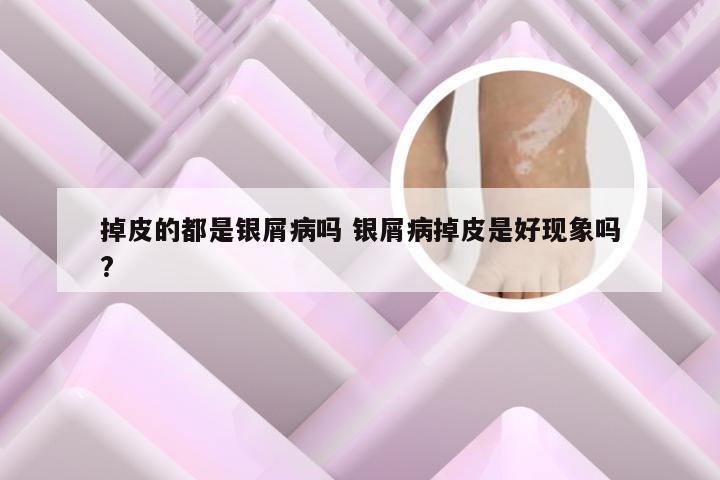 掉皮的都是银屑病吗 银屑病掉皮是好现象吗?