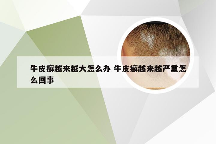 牛皮癣越来越大怎么办 牛皮癣越来越严重怎么回事