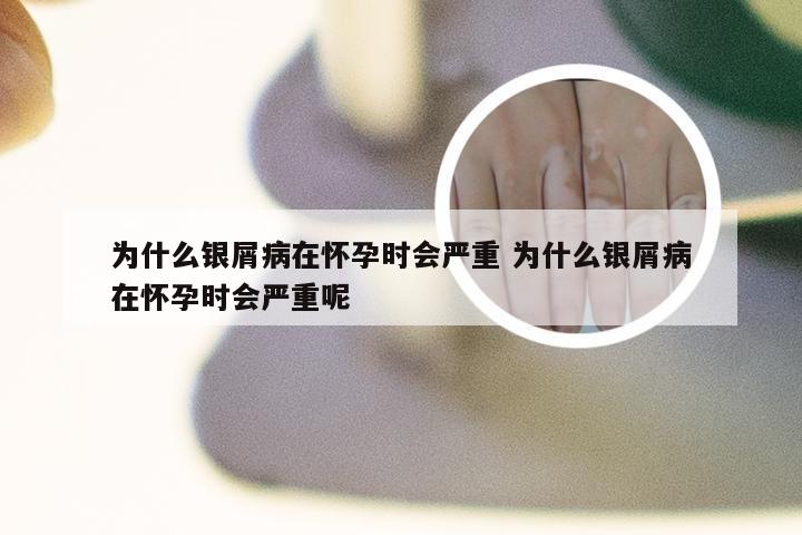 为什么银屑病在怀孕时会严重 为什么银屑病在怀孕时会严重呢