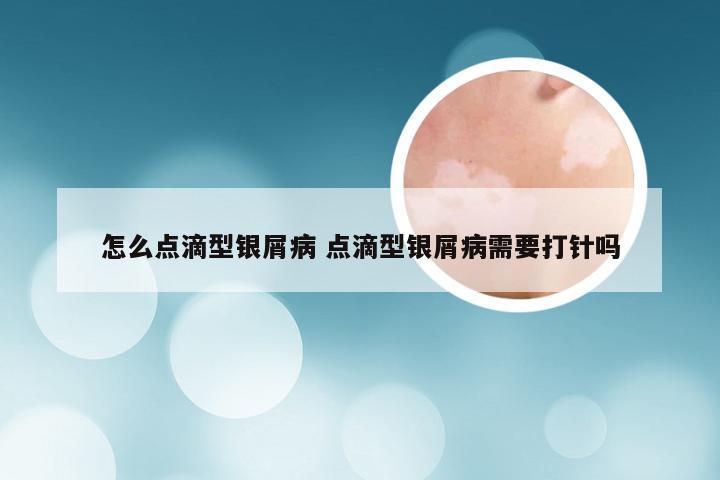 怎么点滴型银屑病 点滴型银屑病需要打针吗