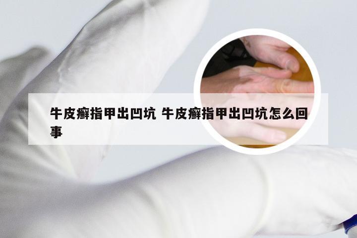 牛皮癣指甲出凹坑 牛皮癣指甲出凹坑怎么回事