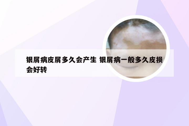 银屑病皮屑多久会产生 银屑病一般多久皮损会好转
