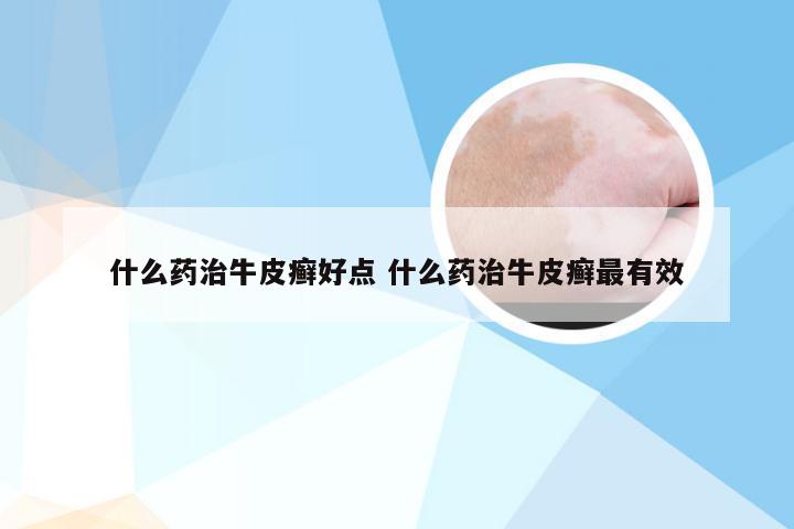 什么药治牛皮癣好点 什么药治牛皮癣最有效