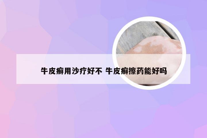 牛皮癣用沙疗好不 牛皮癣擦药能好吗