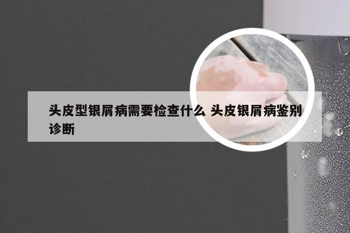 头皮型银屑病需要检查什么 头皮银屑病鉴别诊断