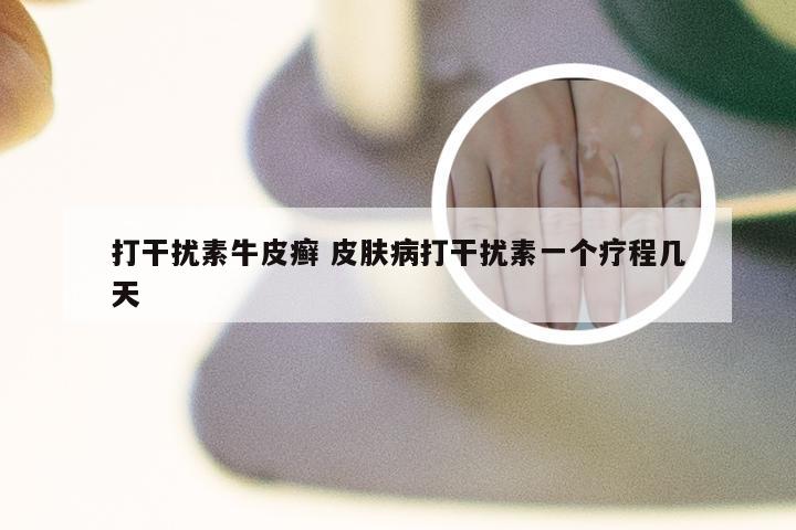 打干扰素牛皮癣 皮肤病打干扰素一个疗程几天