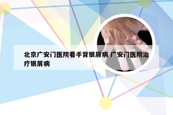 北京广安门医院看手背银屑病 广安门医院治疗银屑病