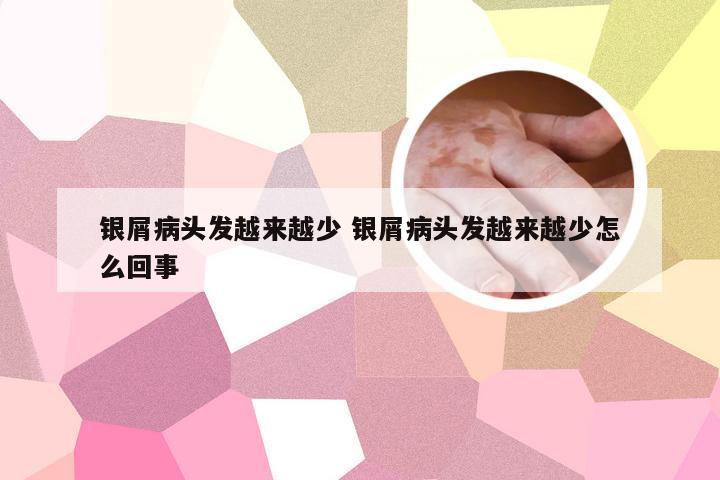 银屑病头发越来越少 银屑病头发越来越少怎么回事