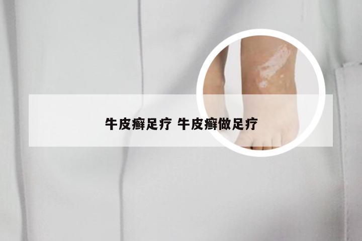 牛皮癣足疗 牛皮癣做足疗