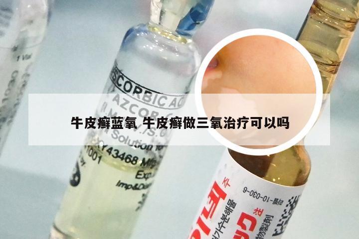 牛皮癣蓝氧 牛皮癣做三氧治疗可以吗