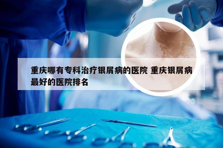 重庆哪有专科治疗银屑病的医院 重庆银屑病最好的医院排名