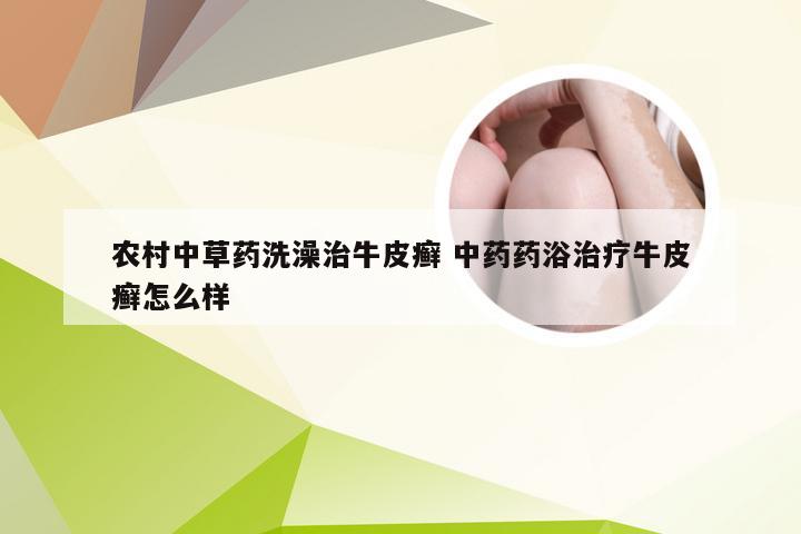 农村中草药洗澡治牛皮癣 中药药浴治疗牛皮癣怎么样