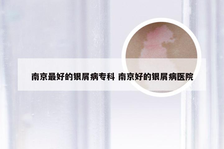 南京最好的银屑病专科 南京好的银屑病医院
