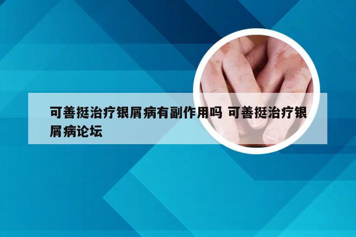 可善挺治疗银屑病有副作用吗 可善挺治疗银屑病论坛