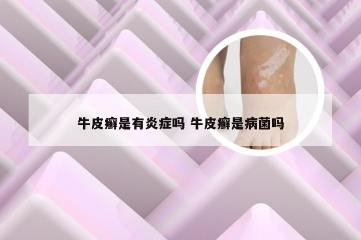 牛皮癣是有炎症吗 牛皮癣是病菌吗