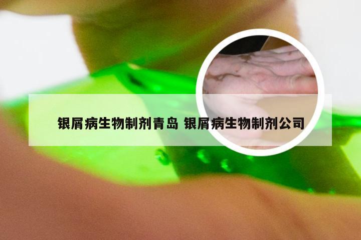 银屑病生物制剂青岛 银屑病生物制剂公司