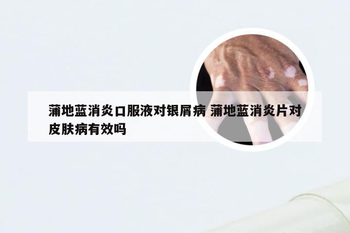 蒲地蓝消炎口服液对银屑病 蒲地蓝消炎片对皮肤病有效吗