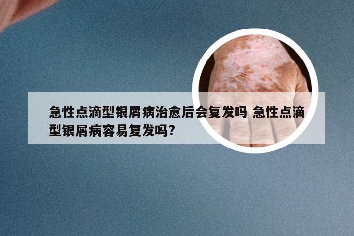 急性点滴型银屑病治愈后会复发吗 急性点滴型银屑病容易复发吗?
