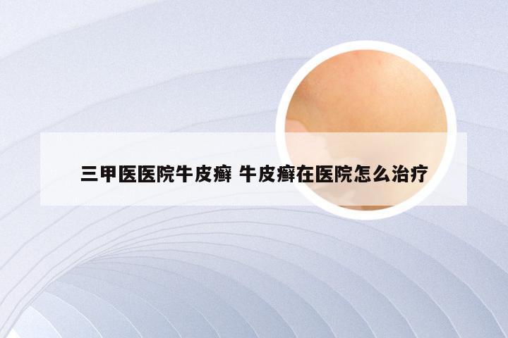 三甲医医院牛皮癣 牛皮癣在医院怎么治疗