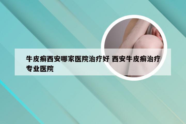 牛皮癣西安哪家医院治疗好 西安牛皮癣治疗专业医院