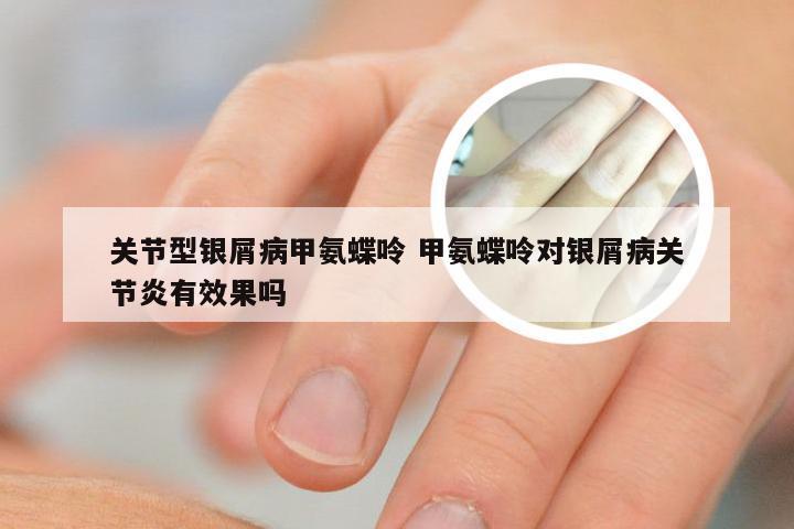 关节型银屑病甲氨蝶呤 甲氨蝶呤对银屑病关节炎有效果吗