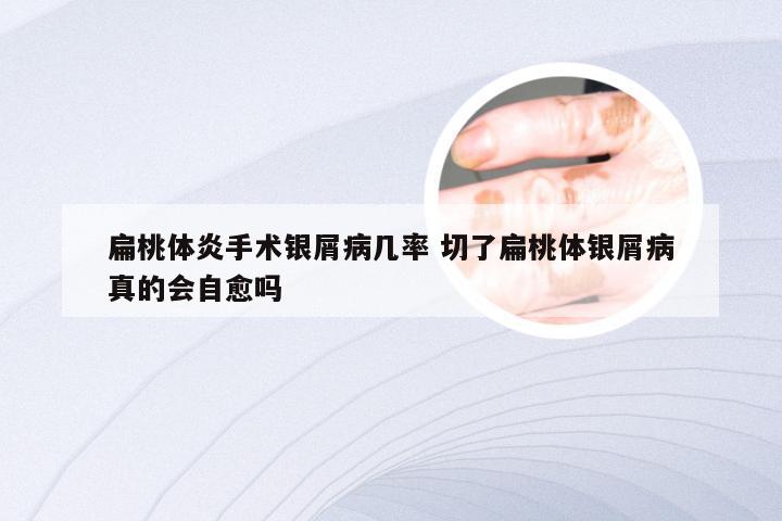 扁桃体炎手术银屑病几率 切了扁桃体银屑病真的会自愈吗