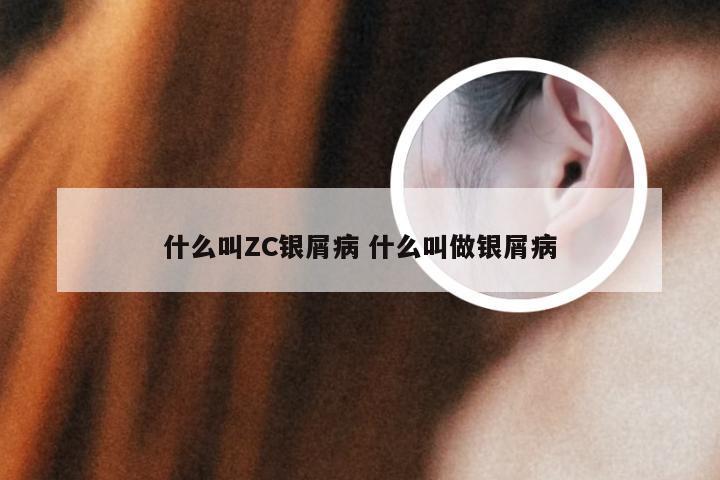 什么叫ZC银屑病 什么叫做银屑病