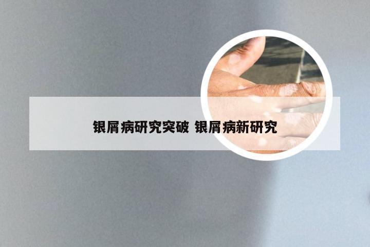 银屑病研究突破 银屑病新研究
