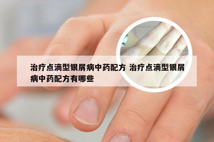 治疗点滴型银屑病中药配方 治疗点滴型银屑病中药配方有哪些