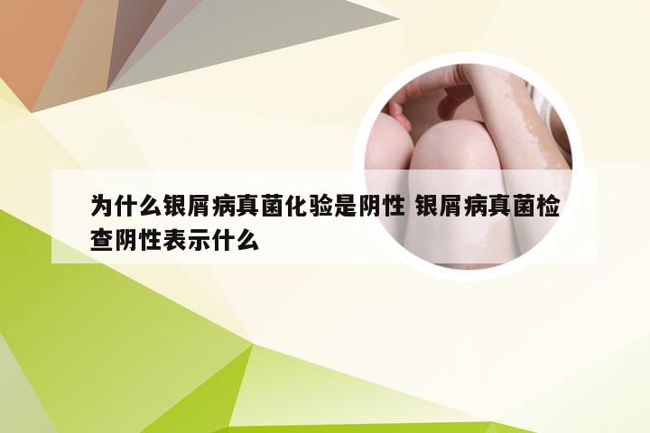 为什么银屑病真菌化验是阴性 银屑病真菌检查阴性表示什么