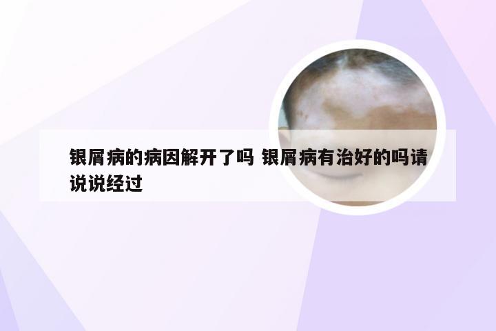 银屑病的病因解开了吗 银屑病有治好的吗请说说经过
