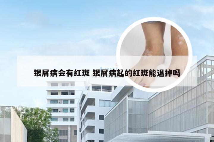 银屑病会有红斑 银屑病起的红斑能退掉吗