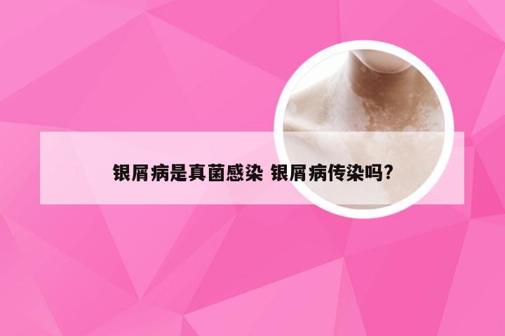 银屑病是真菌感染 银屑病传染吗?