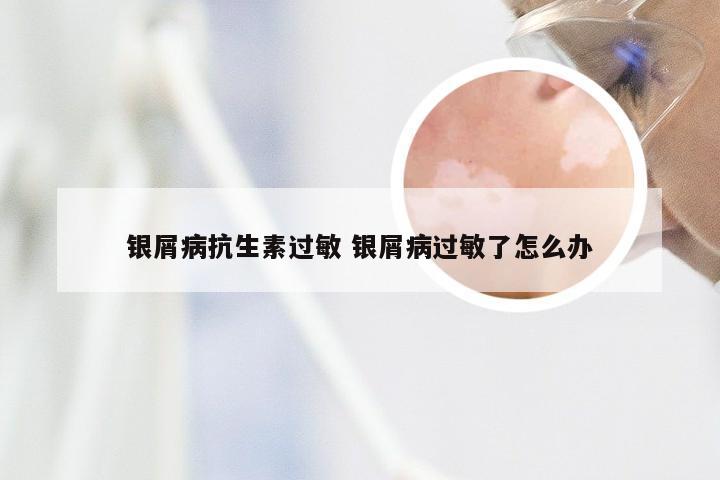 银屑病抗生素过敏 银屑病过敏了怎么办