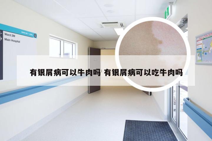 有银屑病可以牛肉吗 有银屑病可以吃牛肉吗