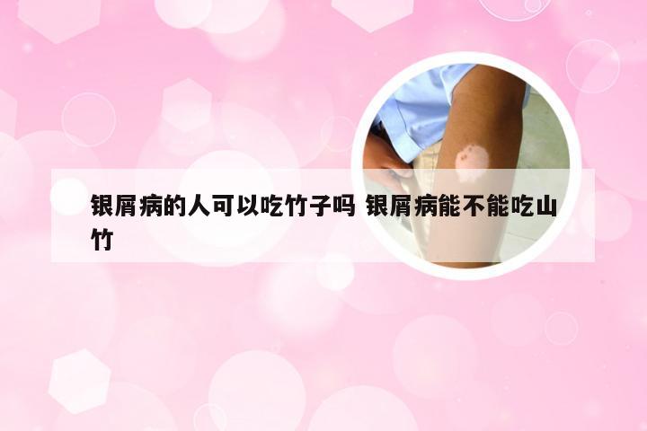 银屑病的人可以吃竹子吗 银屑病能不能吃山竹