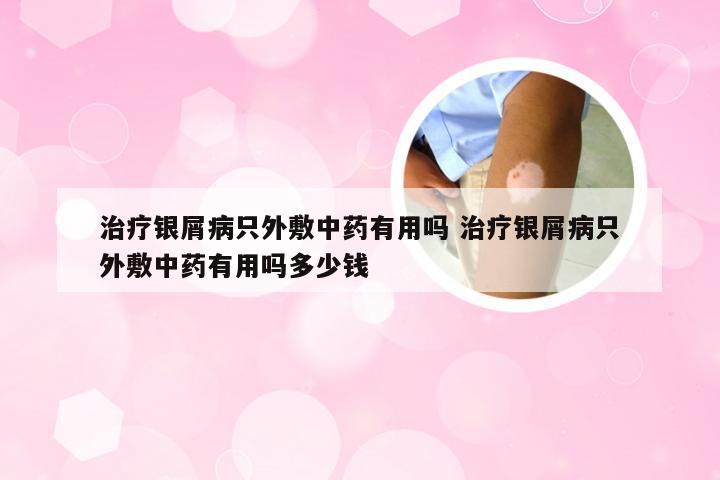 治疗银屑病只外敷中药有用吗 治疗银屑病只外敷中药有用吗多少钱