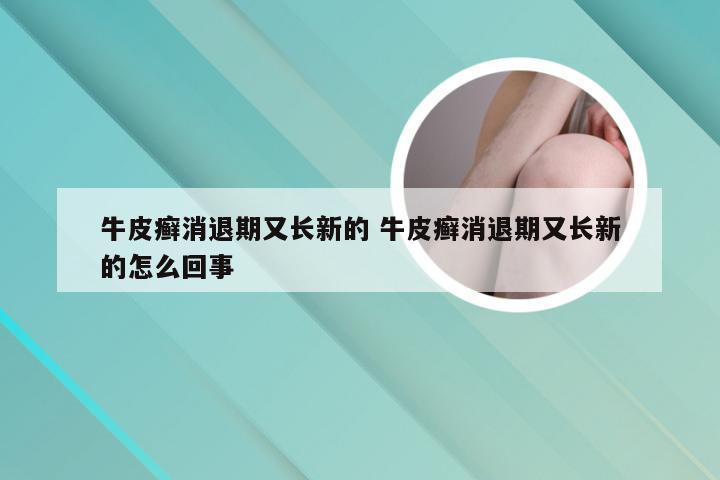 牛皮癣消退期又长新的 牛皮癣消退期又长新的怎么回事