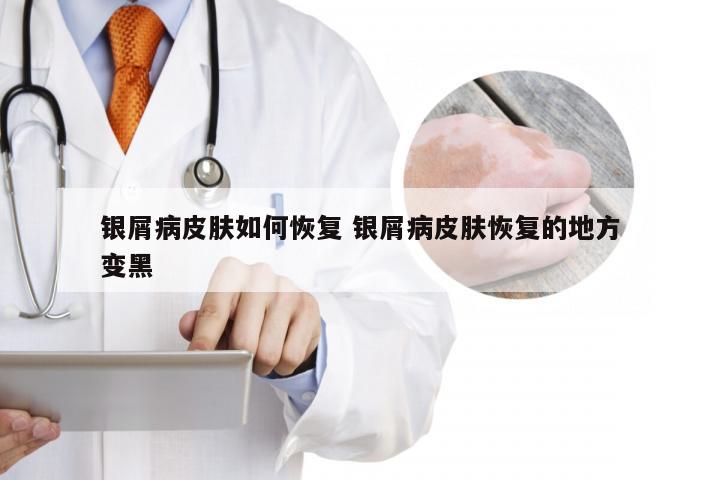 银屑病皮肤如何恢复 银屑病皮肤恢复的地方变黑