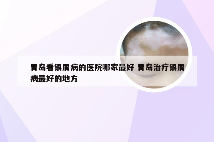 青岛看银屑病的医院哪家最好 青岛治疗银屑病最好的地方