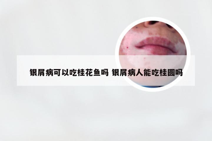 银屑病可以吃桂花鱼吗 银屑病人能吃桂圆吗