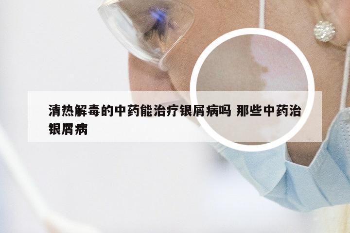 清热解毒的中药能治疗银屑病吗 那些中药治银屑病