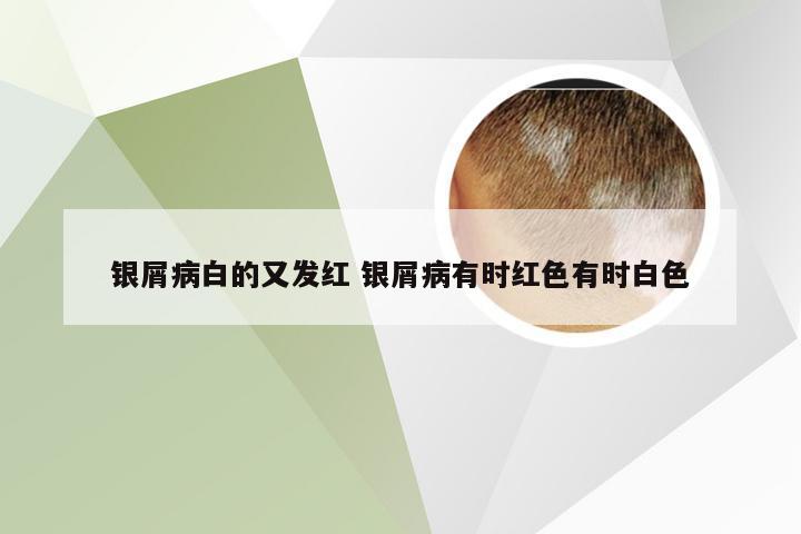 银屑病白的又发红 银屑病有时红色有时白色