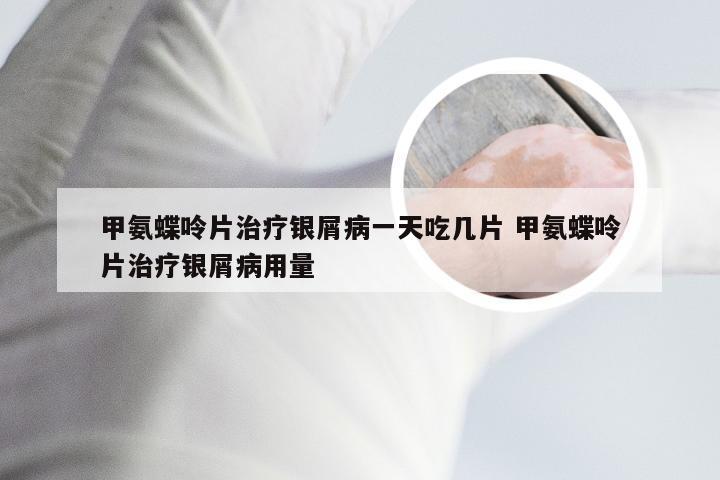 甲氨蝶呤片治疗银屑病一天吃几片 甲氨蝶呤片治疗银屑病用量