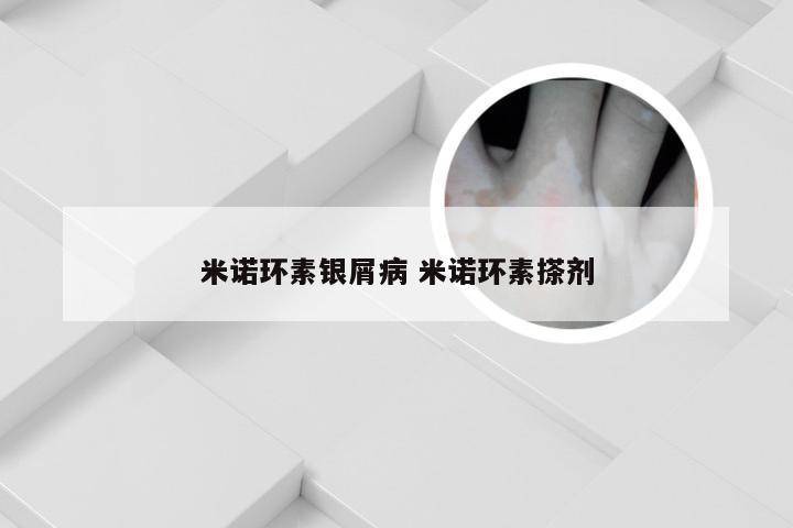 米诺环素银屑病 米诺环素搽剂